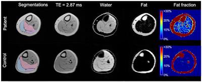 Combination of Quantitative MRI Fat Fraction and Texture Analysis to Evaluate Spastic Muscles of Children With Cerebral Palsy